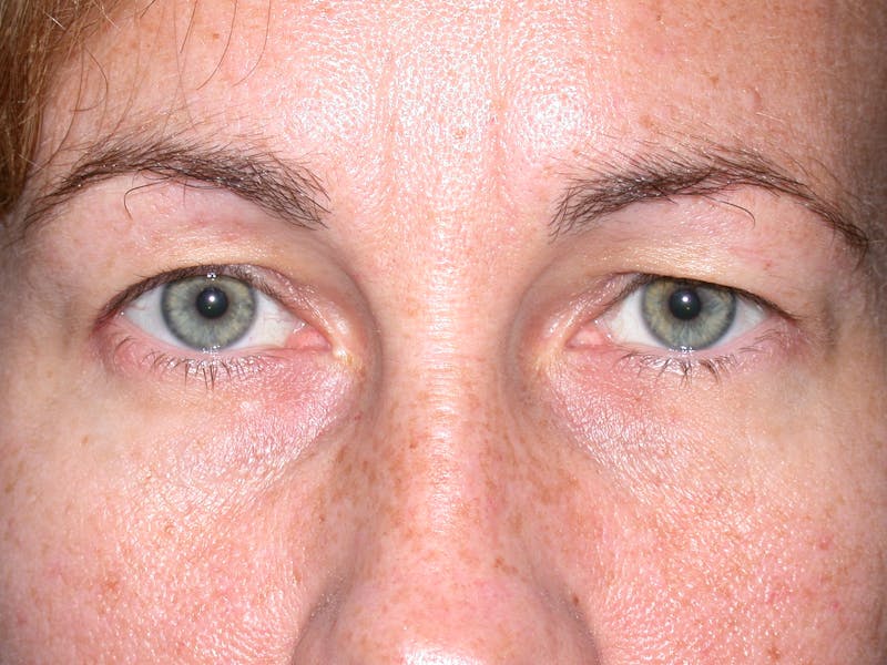 Cosmetic Surgeries Before & After Gallery - Patient 286966 - Image 1
