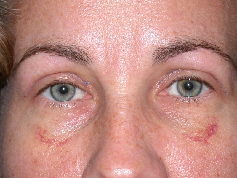 Cosmetic Surgeries Before & After Gallery - Patient 286966 - Image 2