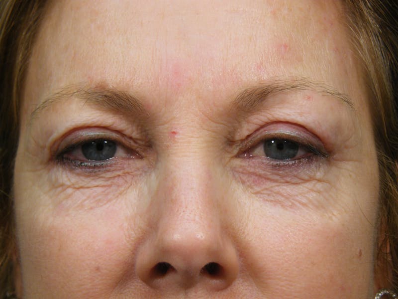 Cosmetic Surgeries Before & After Gallery - Patient 172846 - Image 1