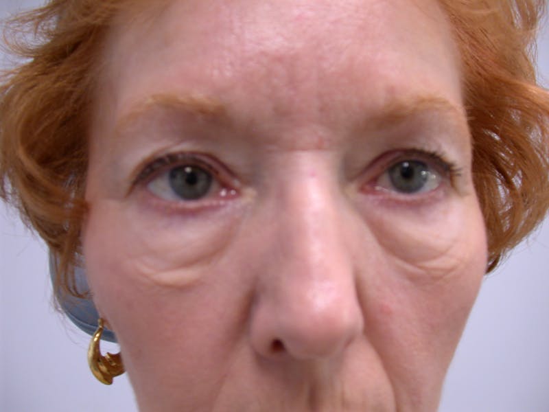 Cosmetic Surgeries Before & After Gallery - Patient 165222 - Image 1