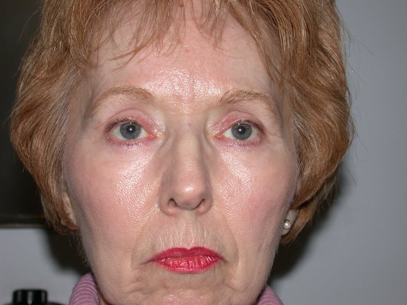 Cosmetic Surgeries Before & After Gallery - Patient 165222 - Image 2