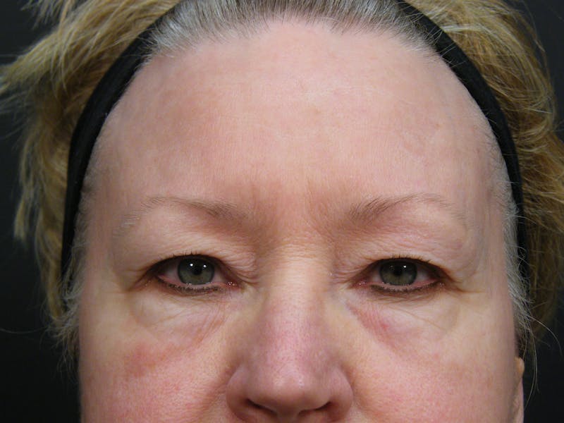 Cosmetic Surgeries Before & After Gallery - Patient 727574 - Image 1