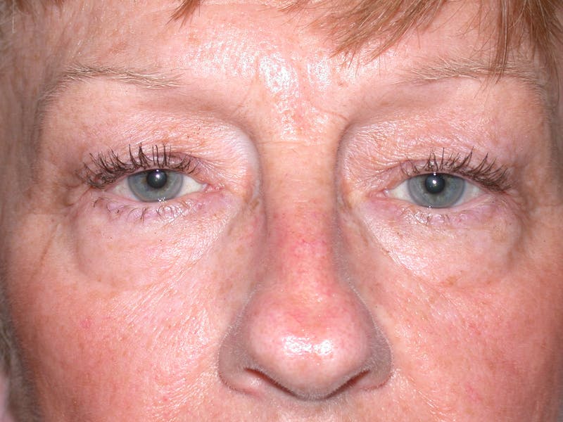 Cosmetic Surgeries Before & After Gallery - Patient 284921 - Image 1