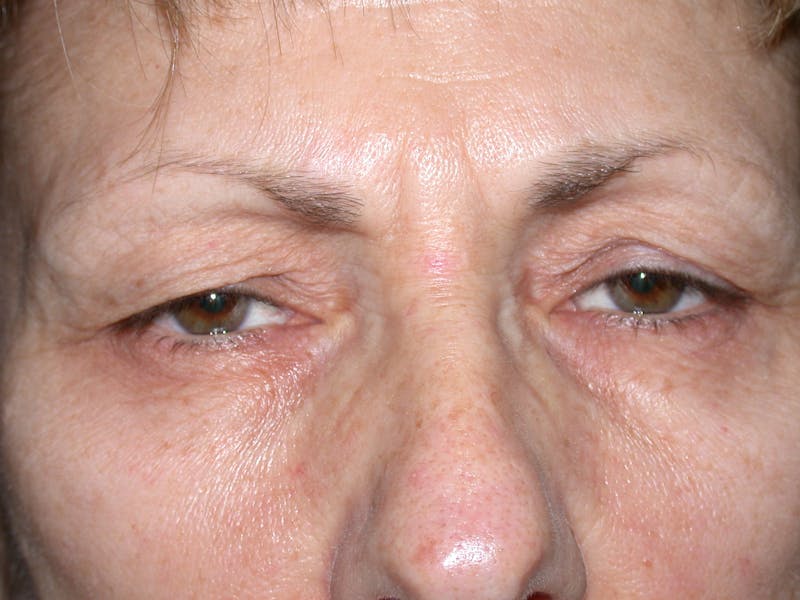 Cosmetic Surgeries Before & After Gallery - Patient 400792 - Image 1