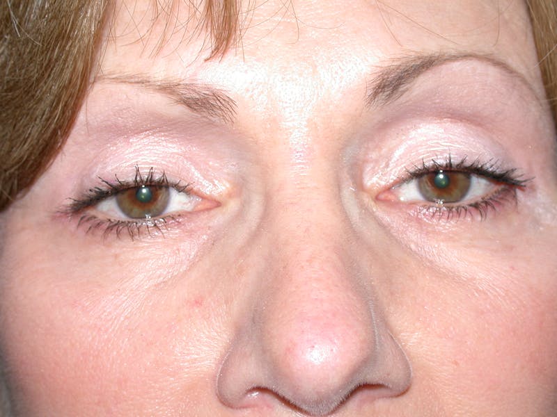 Cosmetic Surgeries Before & After Gallery - Patient 400792 - Image 2