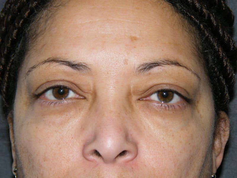 Cosmetic Surgeries Before & After Gallery - Patient 106609 - Image 1