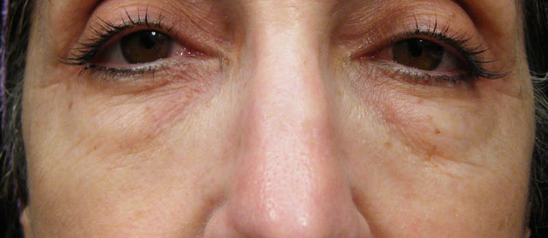 Cosmetic Surgeries Before & After Gallery - Patient 153113 - Image 1