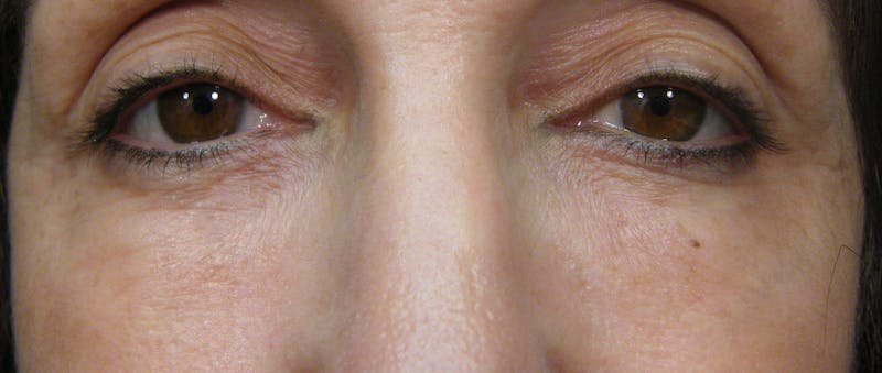 Cosmetic Surgeries Before & After Gallery - Patient 153113 - Image 2