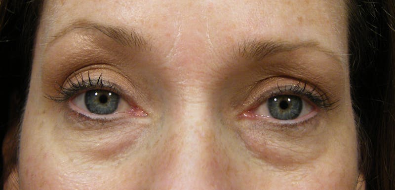 Cosmetic Surgeries Before & After Gallery - Patient 807817 - Image 1