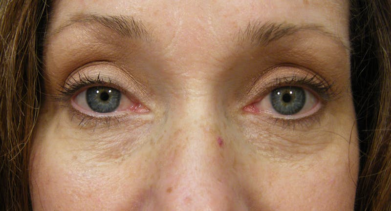Cosmetic Surgeries Before & After Gallery - Patient 807817 - Image 2