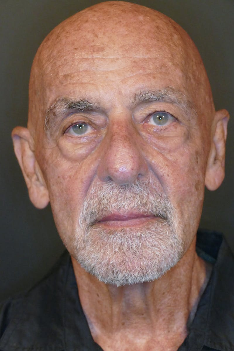 Cosmetic Surgeries Before & After Gallery - Patient 688461 - Image 1