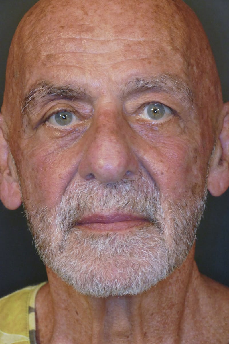 Cosmetic Surgeries Before & After Gallery - Patient 688461 - Image 2