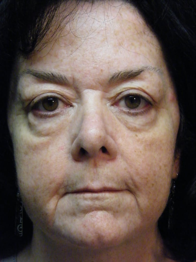 Total Rejuvenation Before & After Gallery - Patient 103589 - Image 1