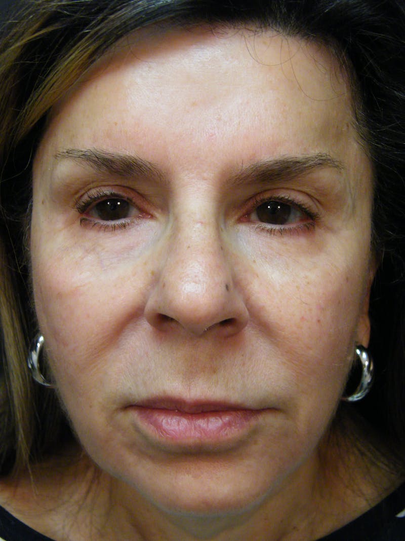 Total Rejuvenation Before & After Gallery - Patient 140797 - Image 2
