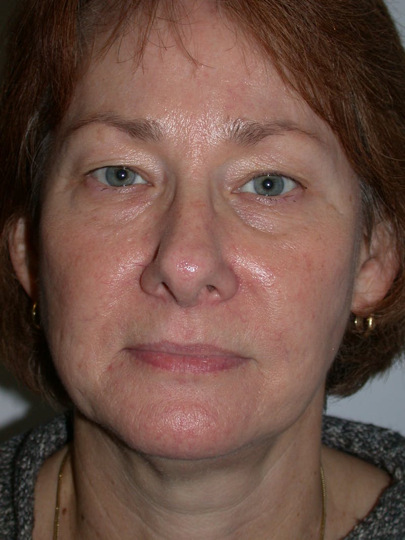 Thermage Before & After Gallery - Patient 160400 - Image 2