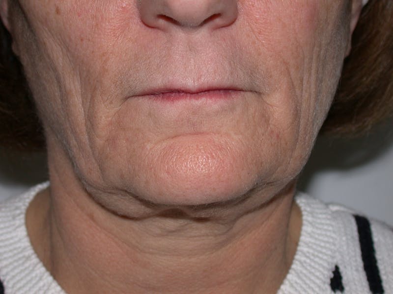 Thermage Before & After Gallery - Patient 246763 - Image 1