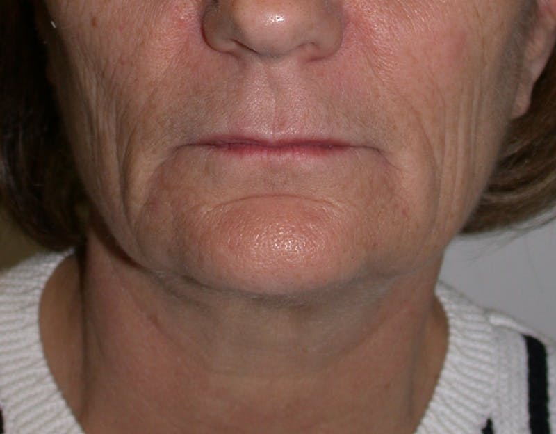 Thermage Before & After Gallery - Patient 246763 - Image 2