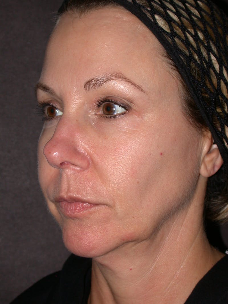 Thermage Before & After Gallery - Patient 304857 - Image 1