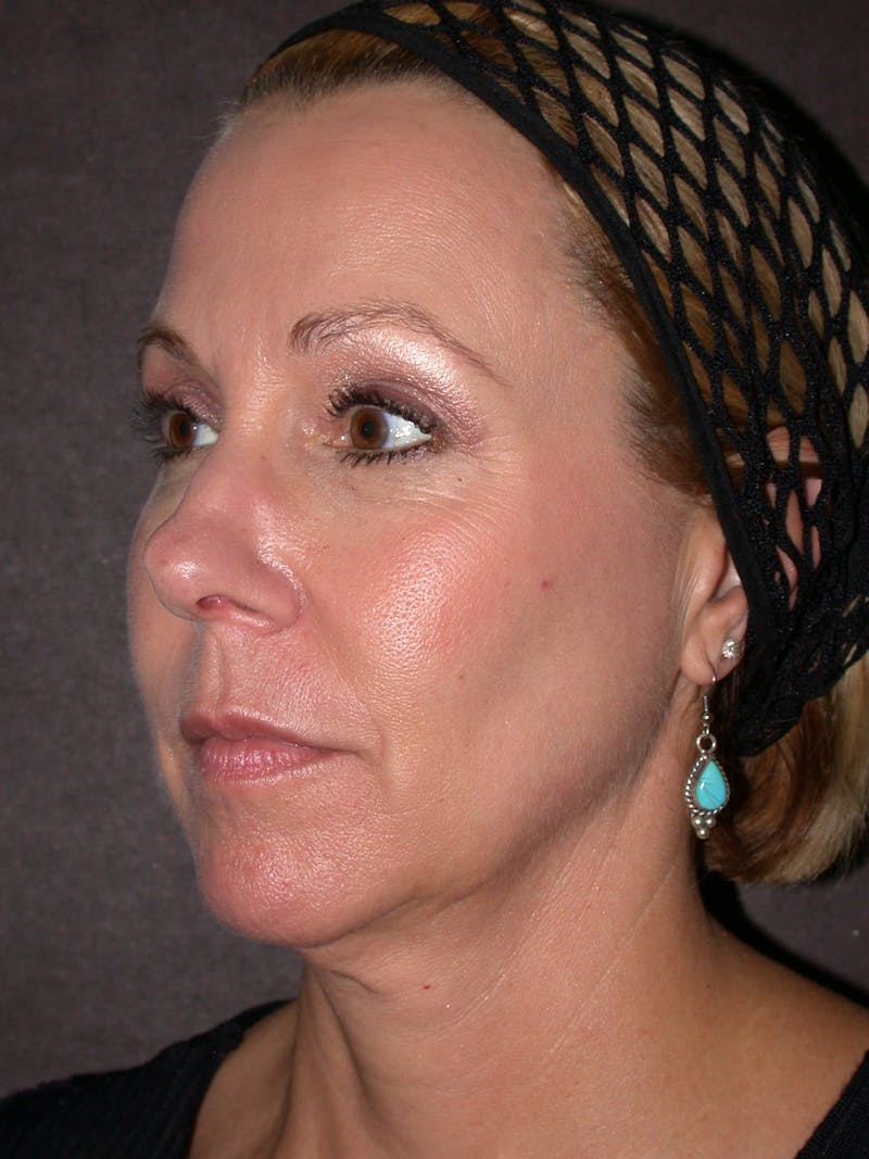 Thermage Before & After Gallery - Patient 304857 - Image 2
