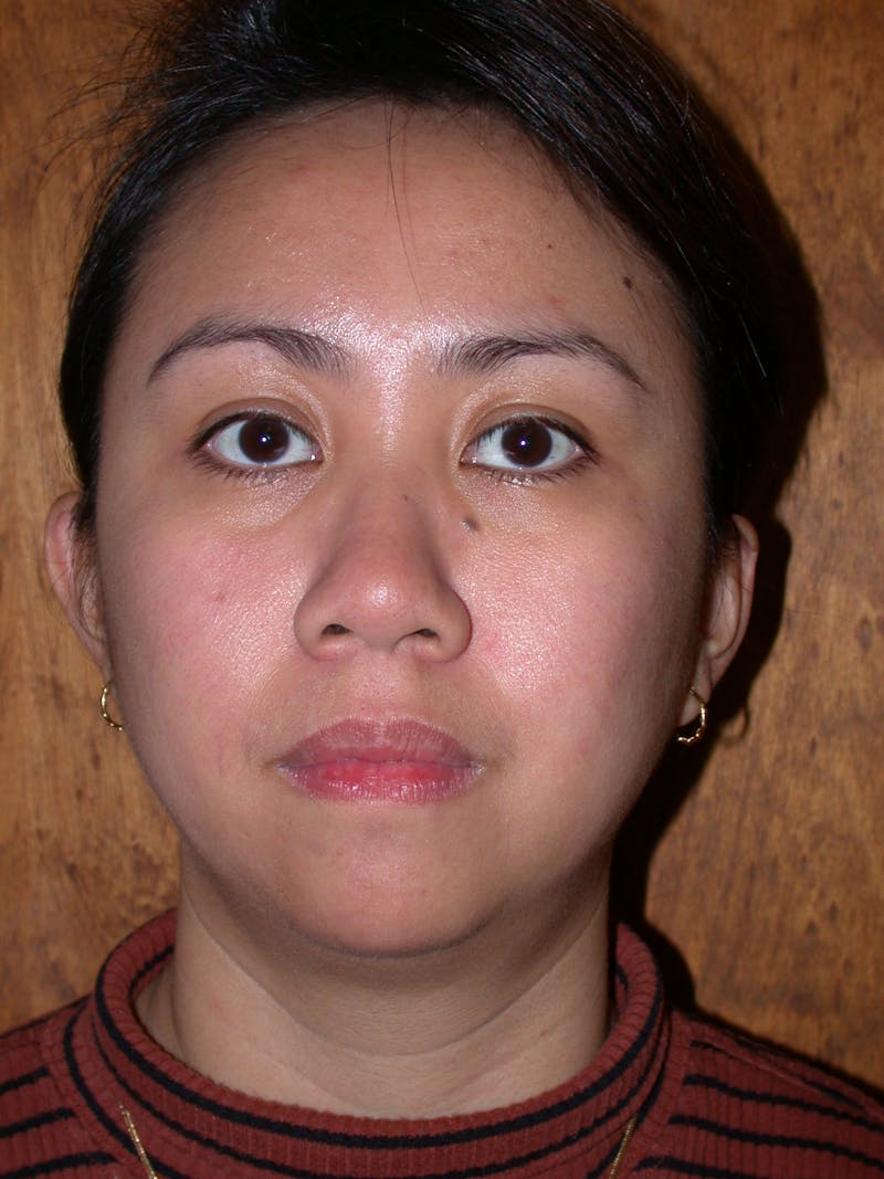 Thermage Before & After Gallery - Patient 228823 - Image 2