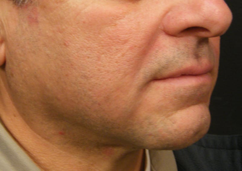 Thermage Before & After Gallery - Patient 324016 - Image 2