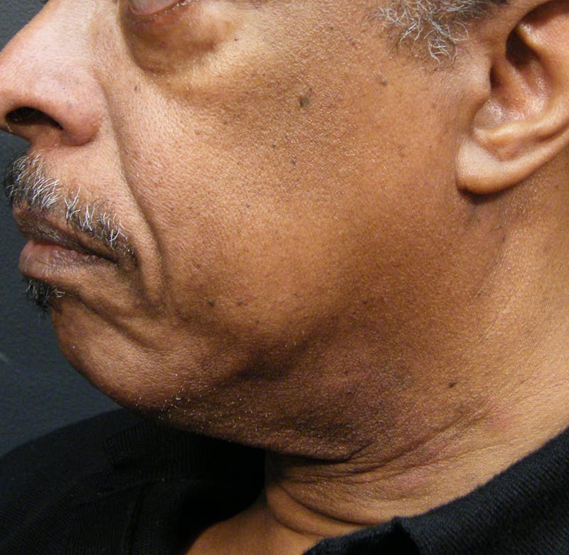 Thermage Before & After Gallery - Patient 339415 - Image 1