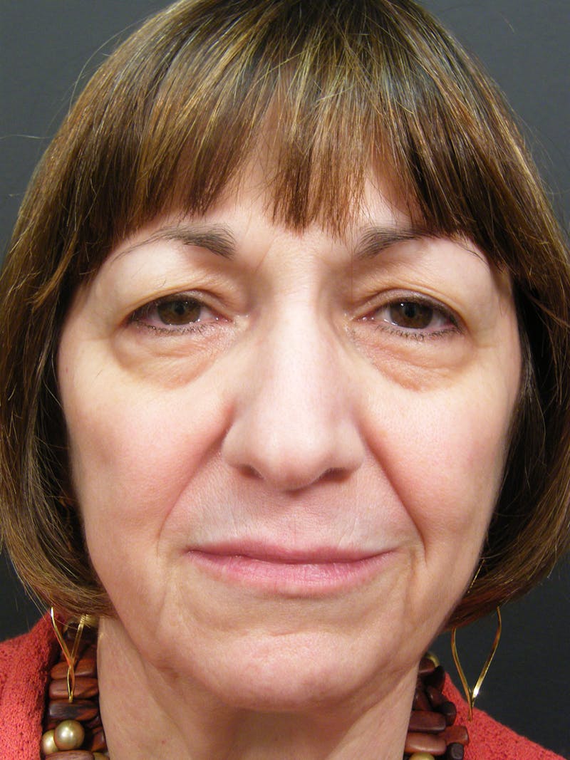 Liquid Facelift & Botunlinum Before & After Gallery - Patient 998712 - Image 1