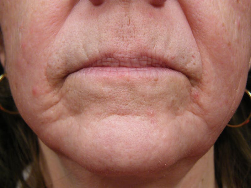Liquid Facelift & Botunlinum Before & After Gallery - Patient 615273 - Image 1