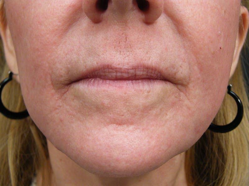 Liquid Facelift & Botunlinum Before & After Gallery - Patient 615273 - Image 2