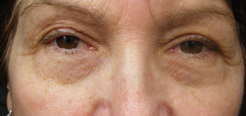 Liquid Facelift & Botunlinum Before & After Gallery - Patient 425490 - Image 1