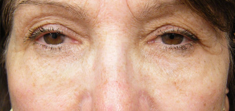 Liquid Facelift & Botunlinum Before & After Gallery - Patient 425490 - Image 2