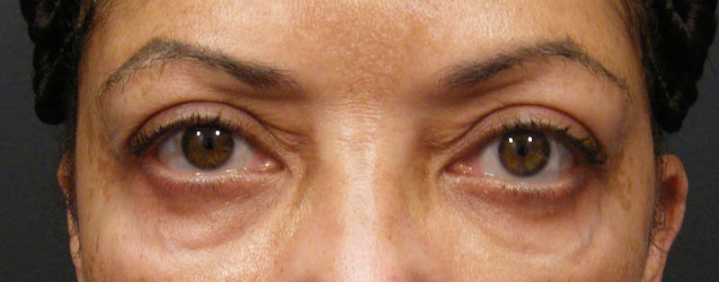 Liquid Facelift & Botunlinum Before & After Gallery - Patient 132177 - Image 1