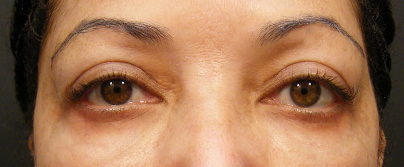 Liquid Facelift & Botunlinum Before & After Gallery - Patient 132177 - Image 2
