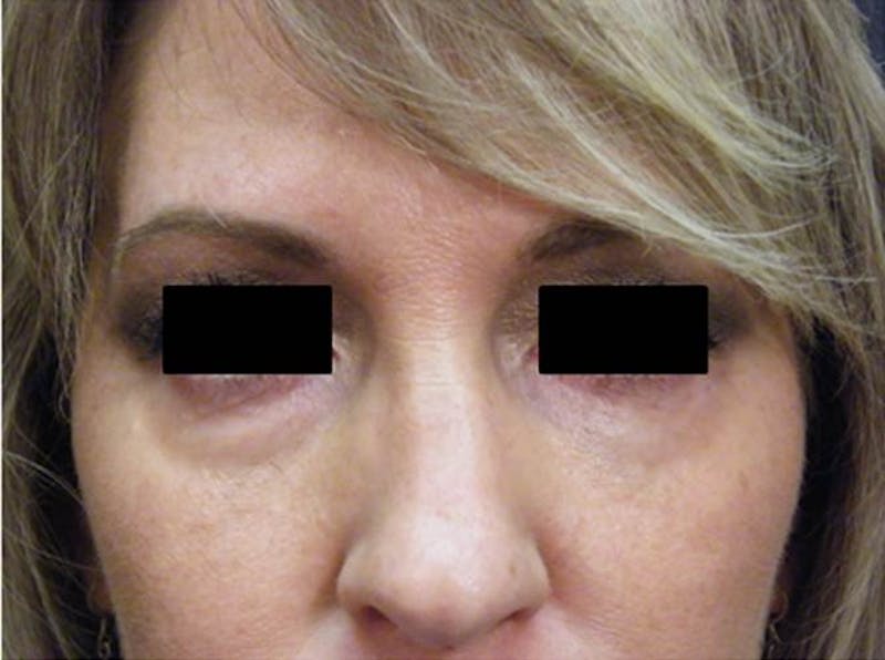 Liquid Facelift & Botunlinum Before & After Gallery - Patient 416245 - Image 1