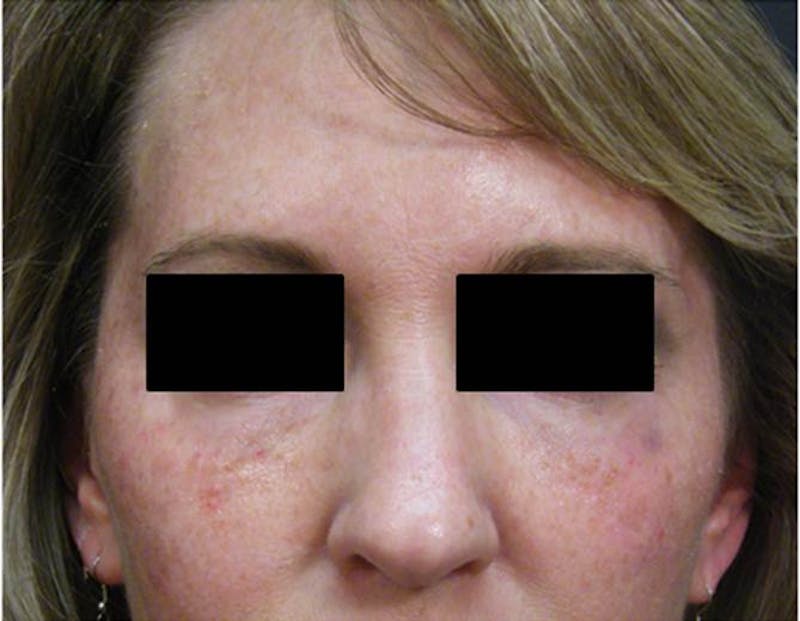 Liquid Facelift & Botunlinum Before & After Gallery - Patient 416245 - Image 2