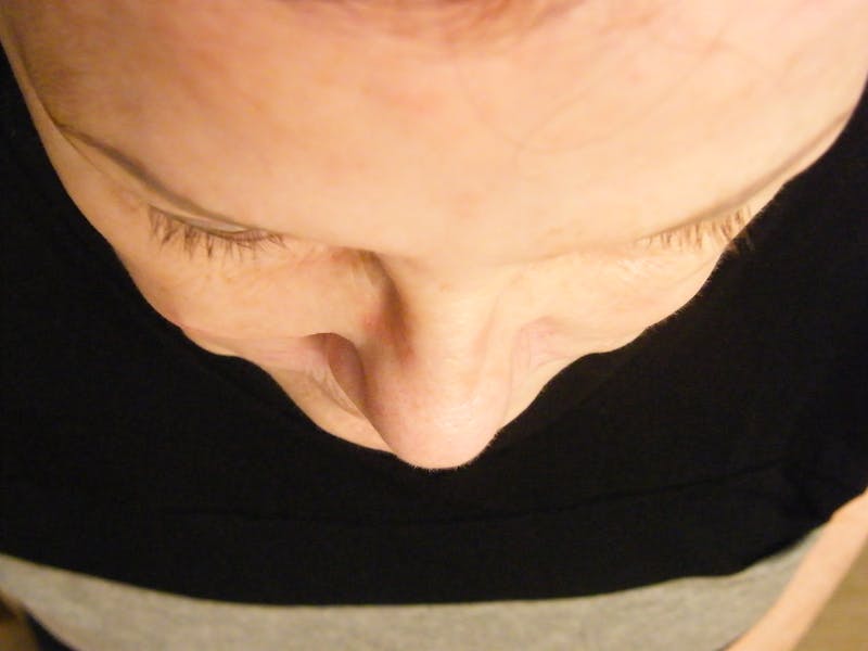 Liquid Facelift & Botunlinum Before & After Gallery - Patient 160315 - Image 1