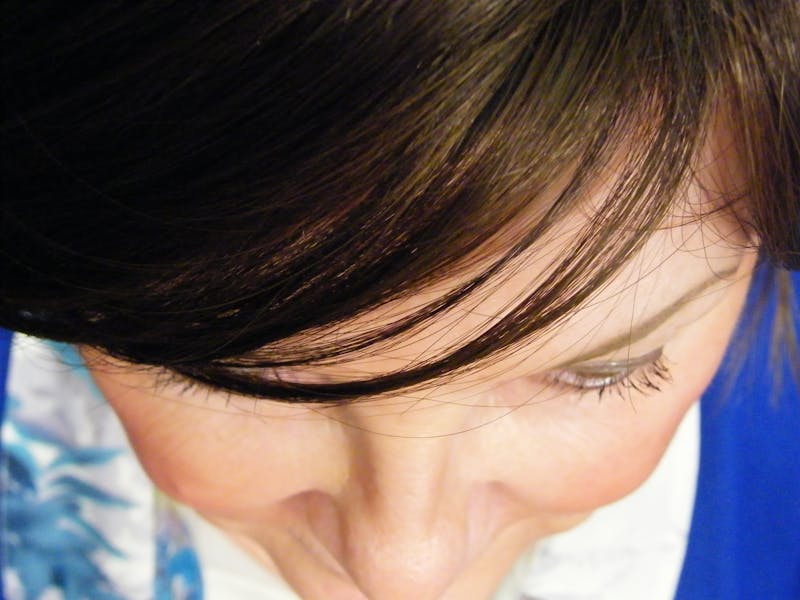 Liquid Facelift & Botunlinum Before & After Gallery - Patient 160315 - Image 2