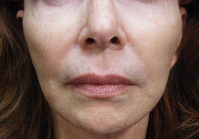 Liquid Facelift & Botunlinum Before & After Gallery - Patient 387498 - Image 1