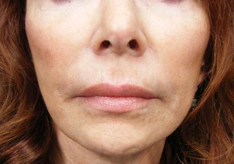 Liquid Facelift & Botunlinum Before & After Gallery - Patient 387498 - Image 2