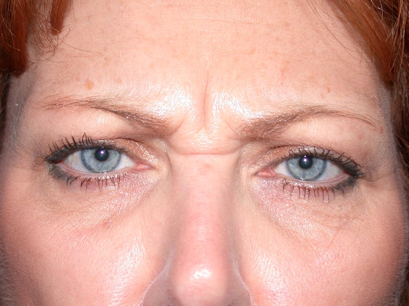 Liquid Facelift & Botunlinum Before & After Gallery - Patient 151571 - Image 1