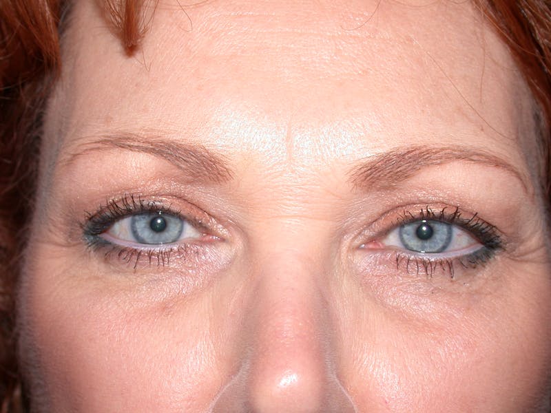 Liquid Facelift & Botunlinum Before & After Gallery - Patient 151571 - Image 2
