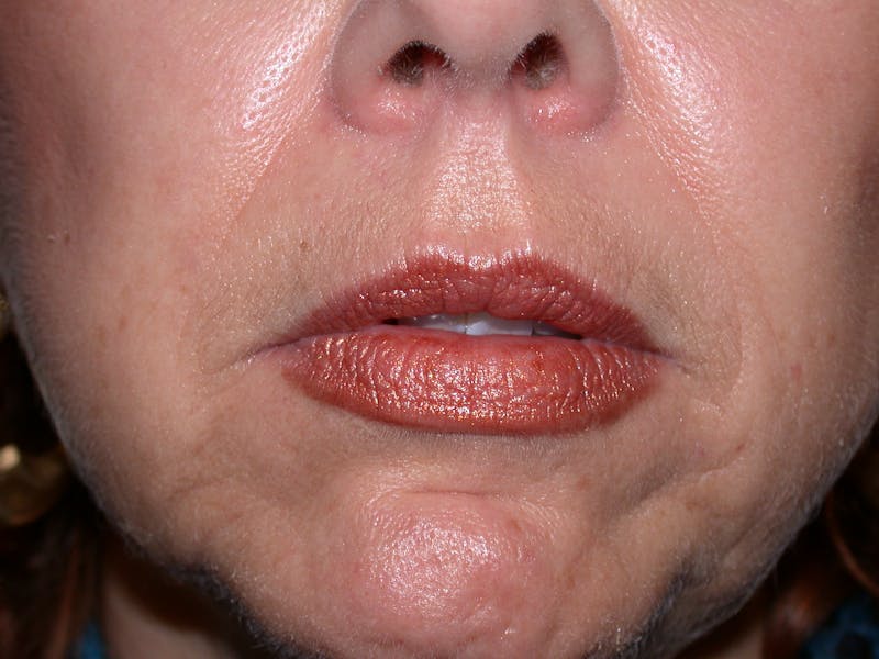 Liquid Facelift & Botunlinum Before & After Gallery - Patient 151571 - Image 3