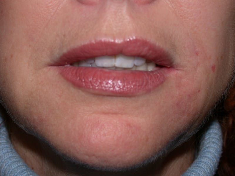 Liquid Facelift & Botunlinum Before & After Gallery - Patient 151571 - Image 4