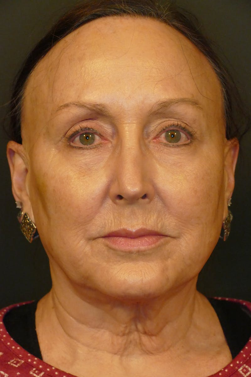 Liquid Facelift & Botunlinum Before & After Gallery - Patient 284569 - Image 1