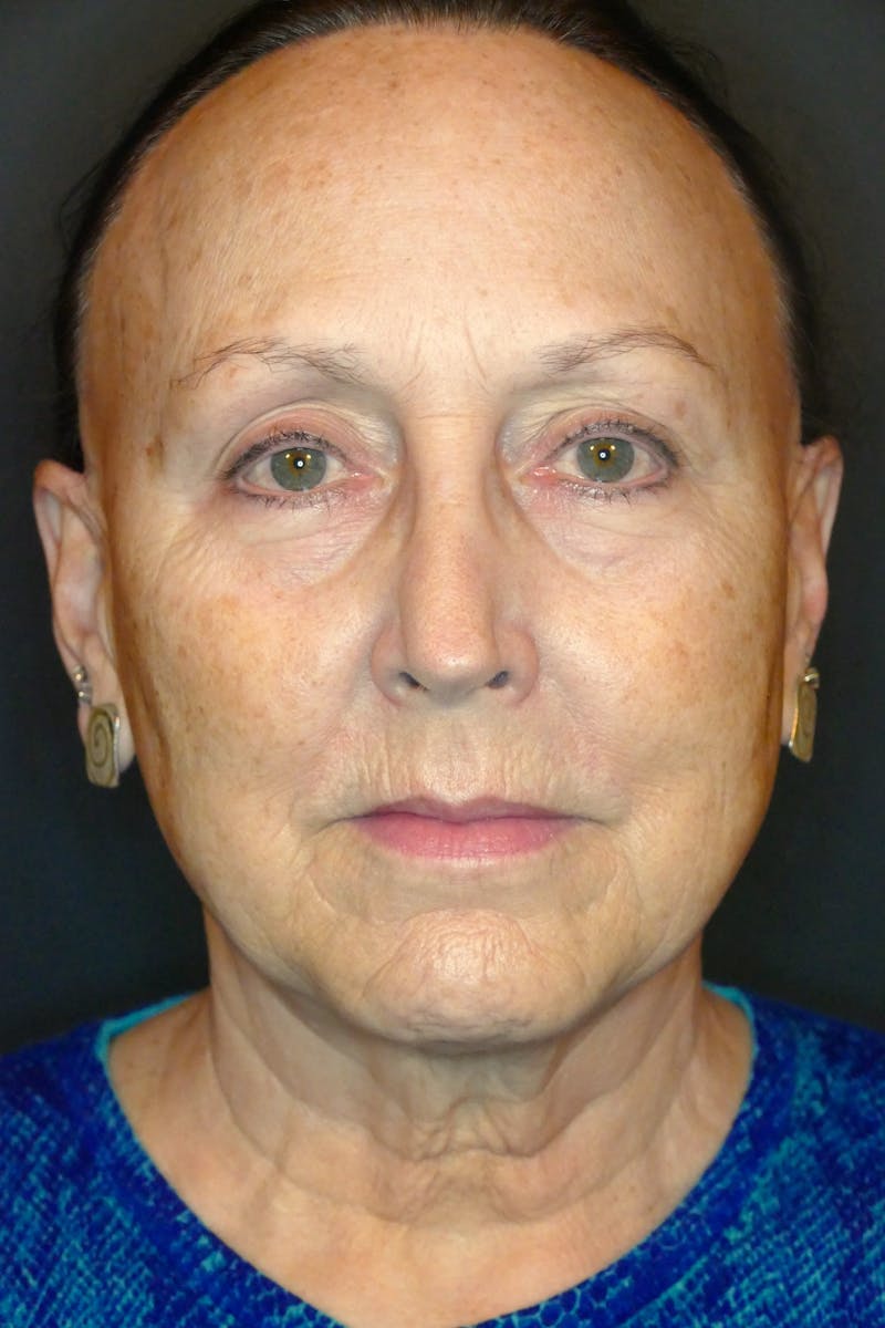 Liquid Facelift & Botunlinum Before & After Gallery - Patient 284569 - Image 2