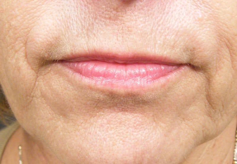Liquid Facelift & Botunlinum Before & After Gallery - Patient 163943 - Image 1