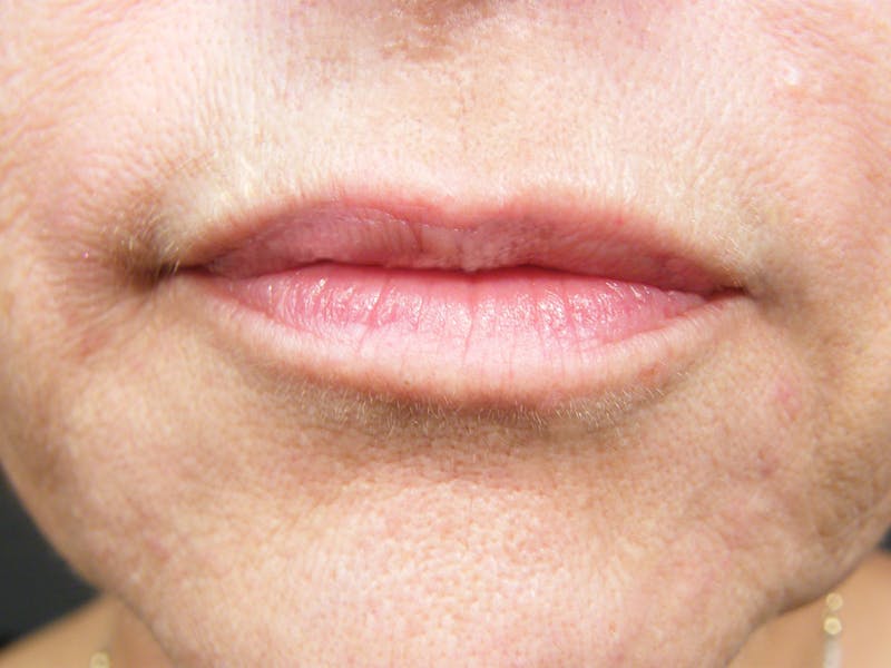 Liquid Facelift & Botunlinum Before & After Gallery - Patient 163943 - Image 2