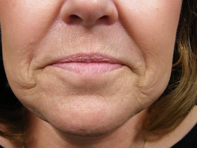 Liquid Facelift & Botunlinum Before & After Gallery - Patient 300307 - Image 1