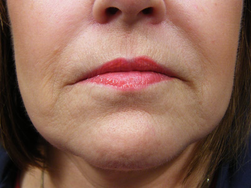 Liquid Facelift & Botunlinum Before & After Gallery - Patient 300307 - Image 2