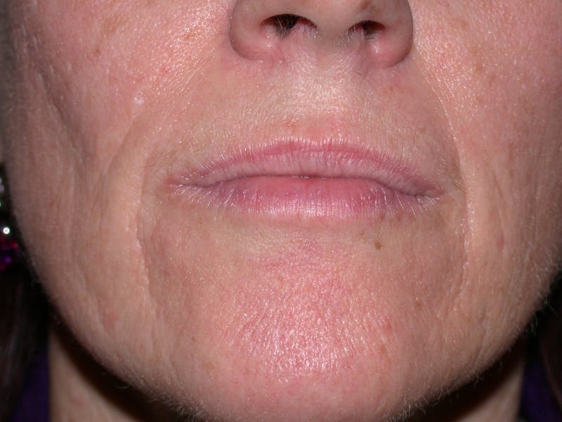 Liquid Facelift & Botunlinum Before & After Gallery - Patient 185270 - Image 1